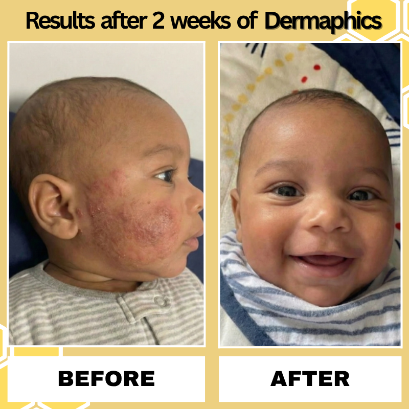 Dermaphics™ Honey Eczema Cream
