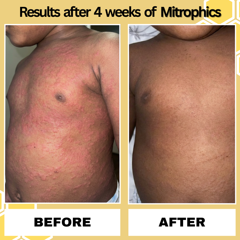 Mitrophics Honey Eczema Cream