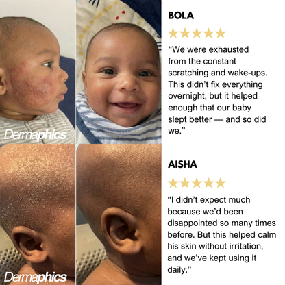 Dermaphics™ Honey Eczema Cream